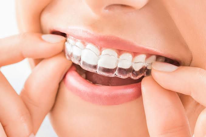 Clear Aligners & Invisalign