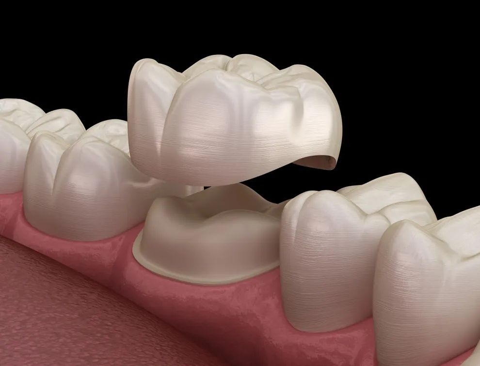 Porcelain Veneers & Ceramics