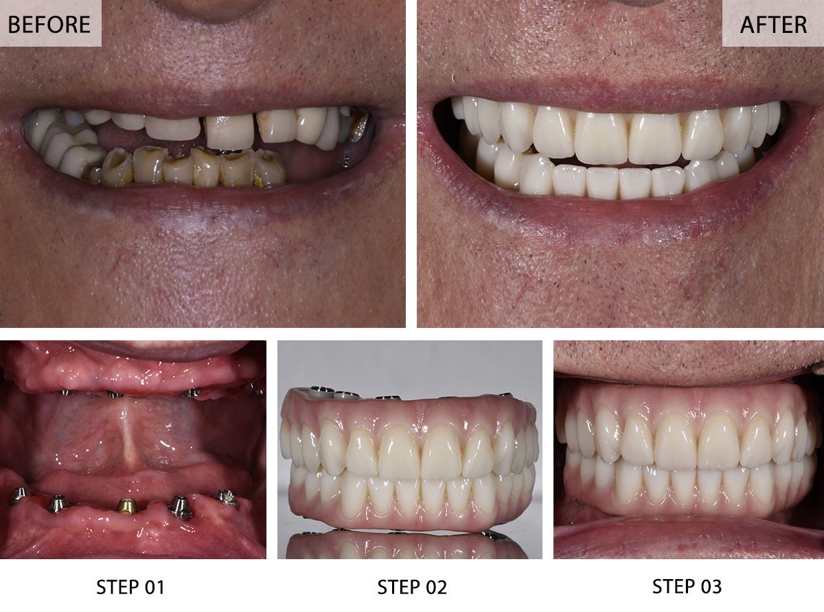 Dental Implants