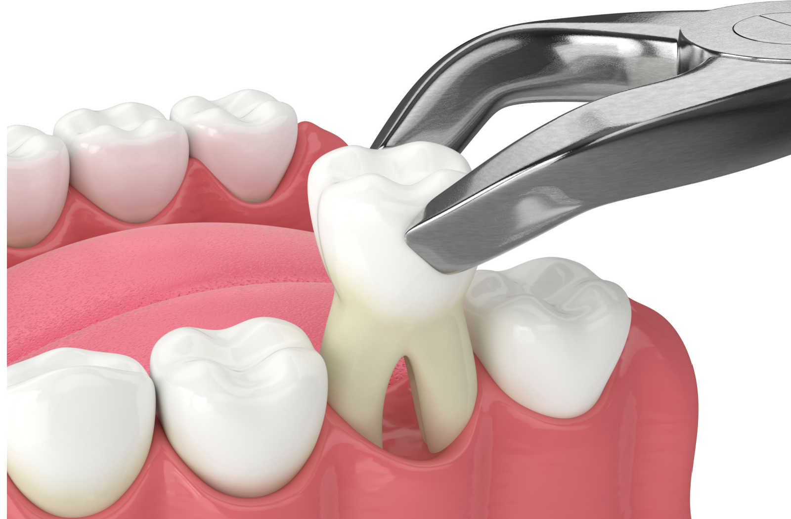 Tooth Extraction & Wisdom Tooth Removal