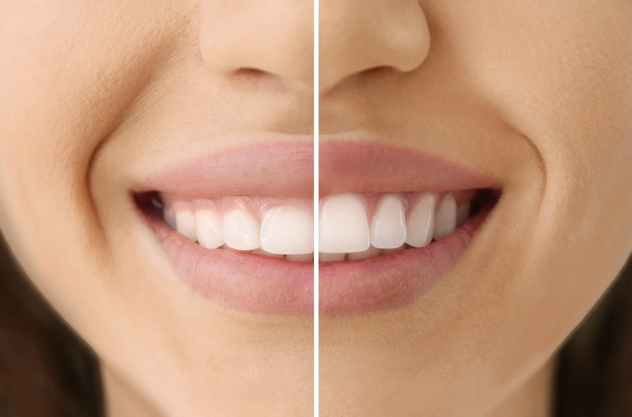 Cosmetic Gum Treatment