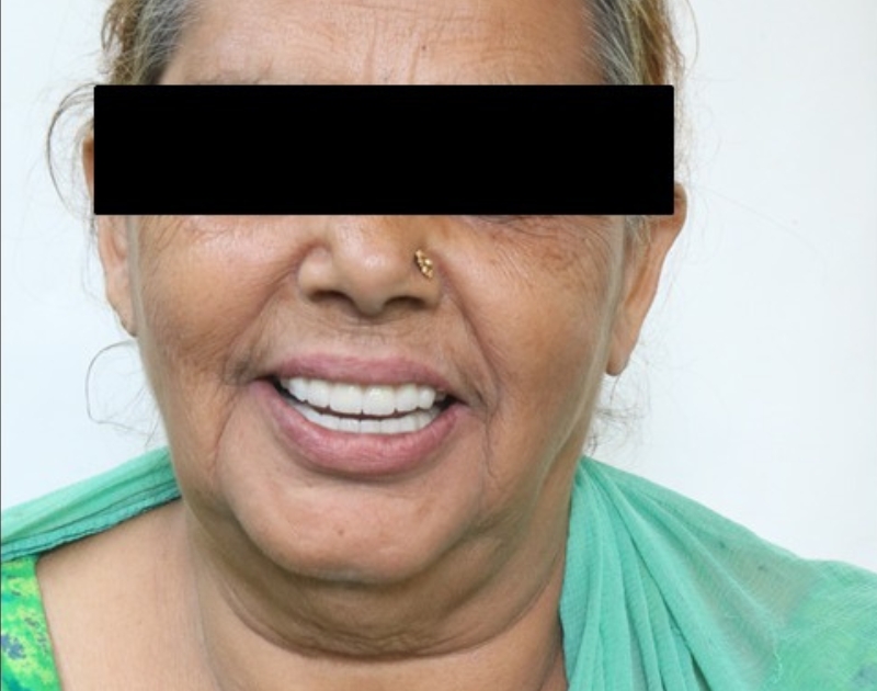 After Smile Makeover