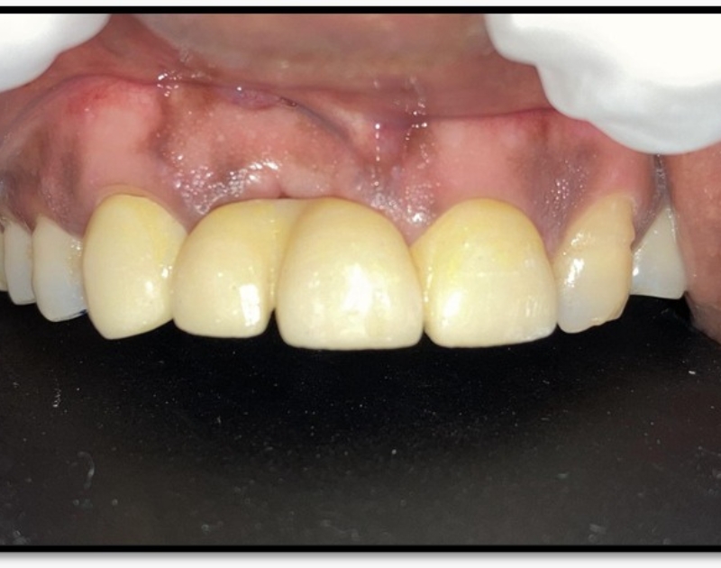 After Smile Makeover