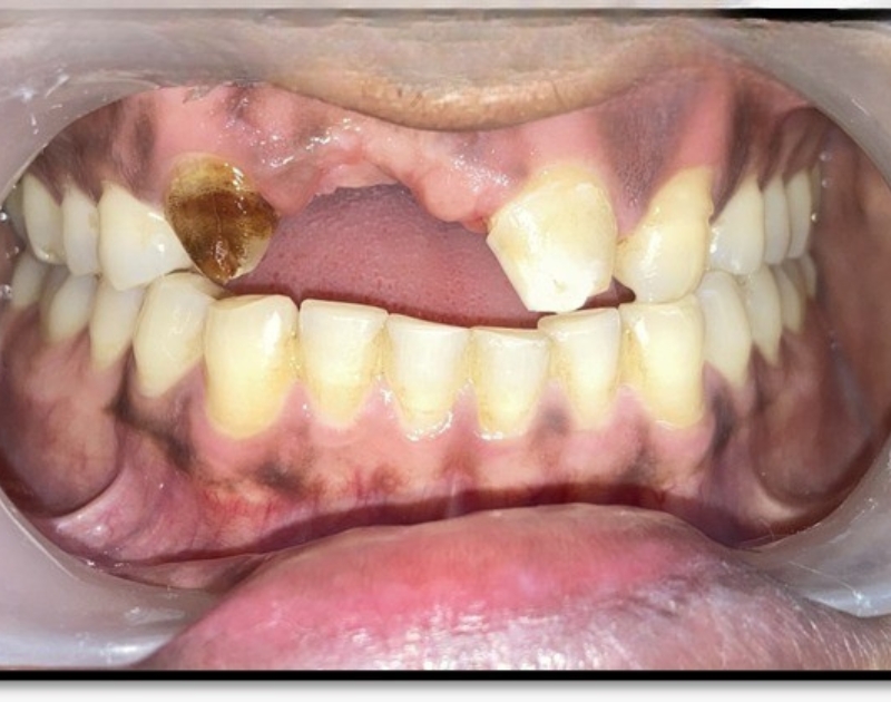 Before Smile Makeover