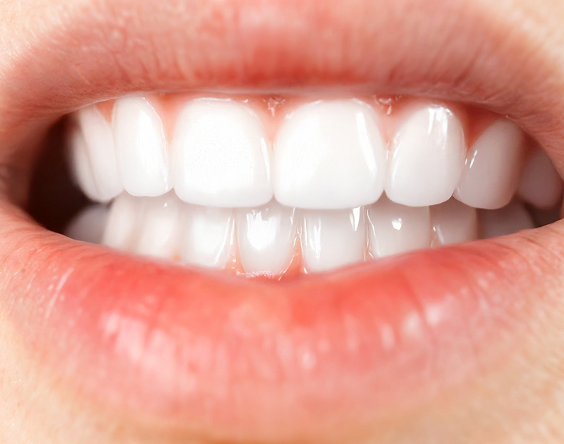 After Clear Aligners