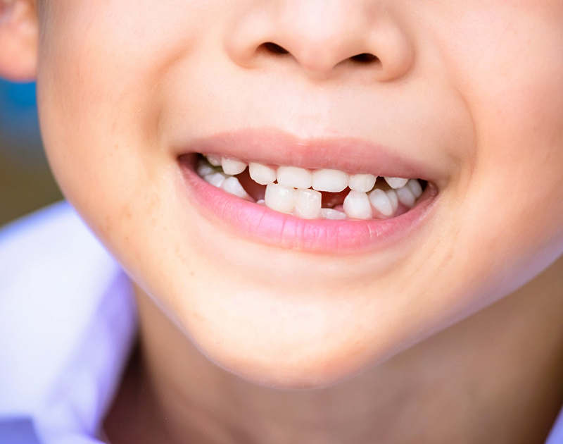 Before Braces Treatment